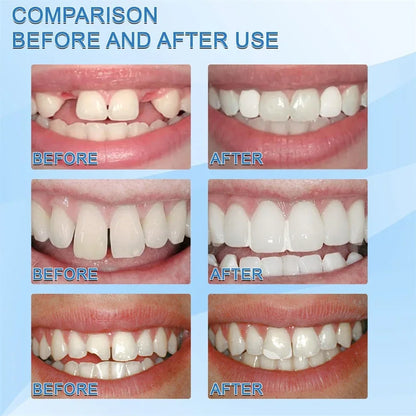 Sorriso instantâneo: Reparo dentário